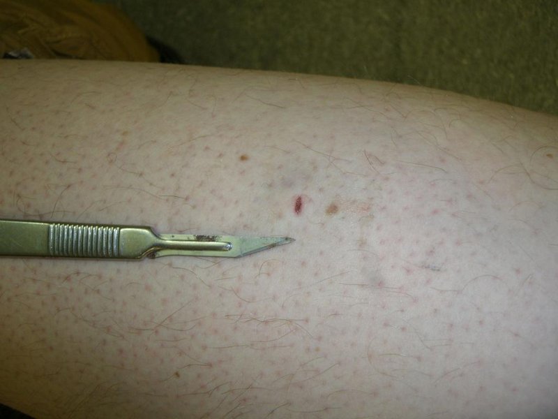 Stecklandung ... Skalpell aus den Fingern gerutscht ... geblutet wie ein Ferkel